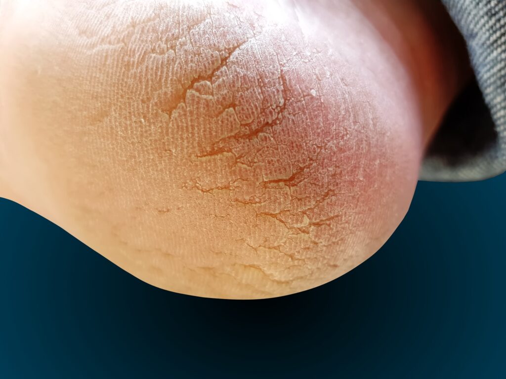 Close-up of cracked heels and skin fissures requiring treatment